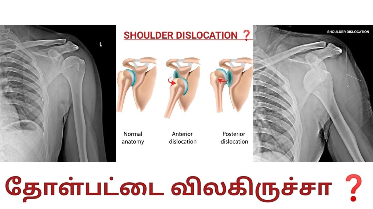 Shoulder Dislocation Types